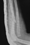 Monteggia fracture-dislocation