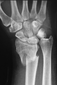 Galeazzi fracture-dislocation