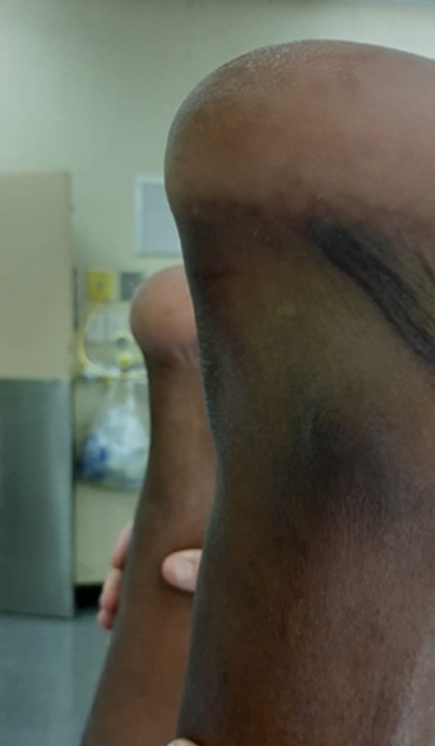 Ecchymosis and gap in the Achilles tendon