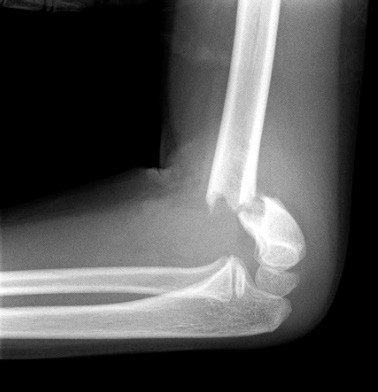 Grade II supracondylar fracture.