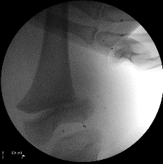 Stress view with valgus force