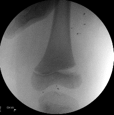 Stress view with varus force