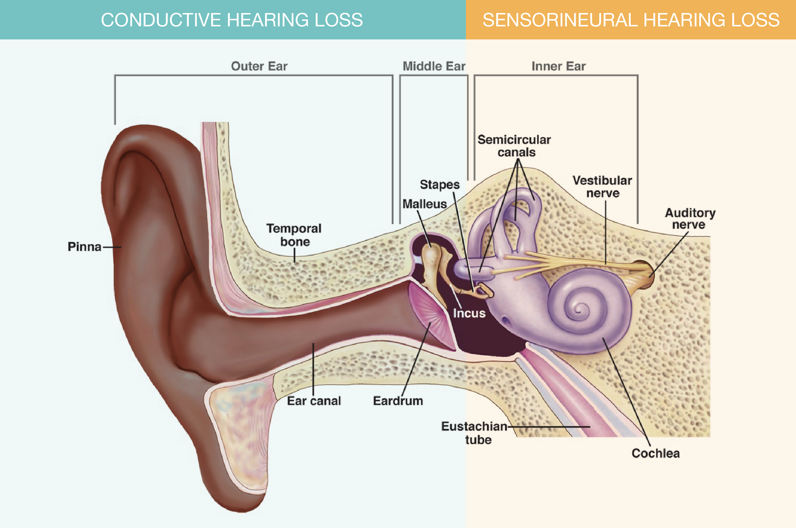 The image is showing different types of hearing loss