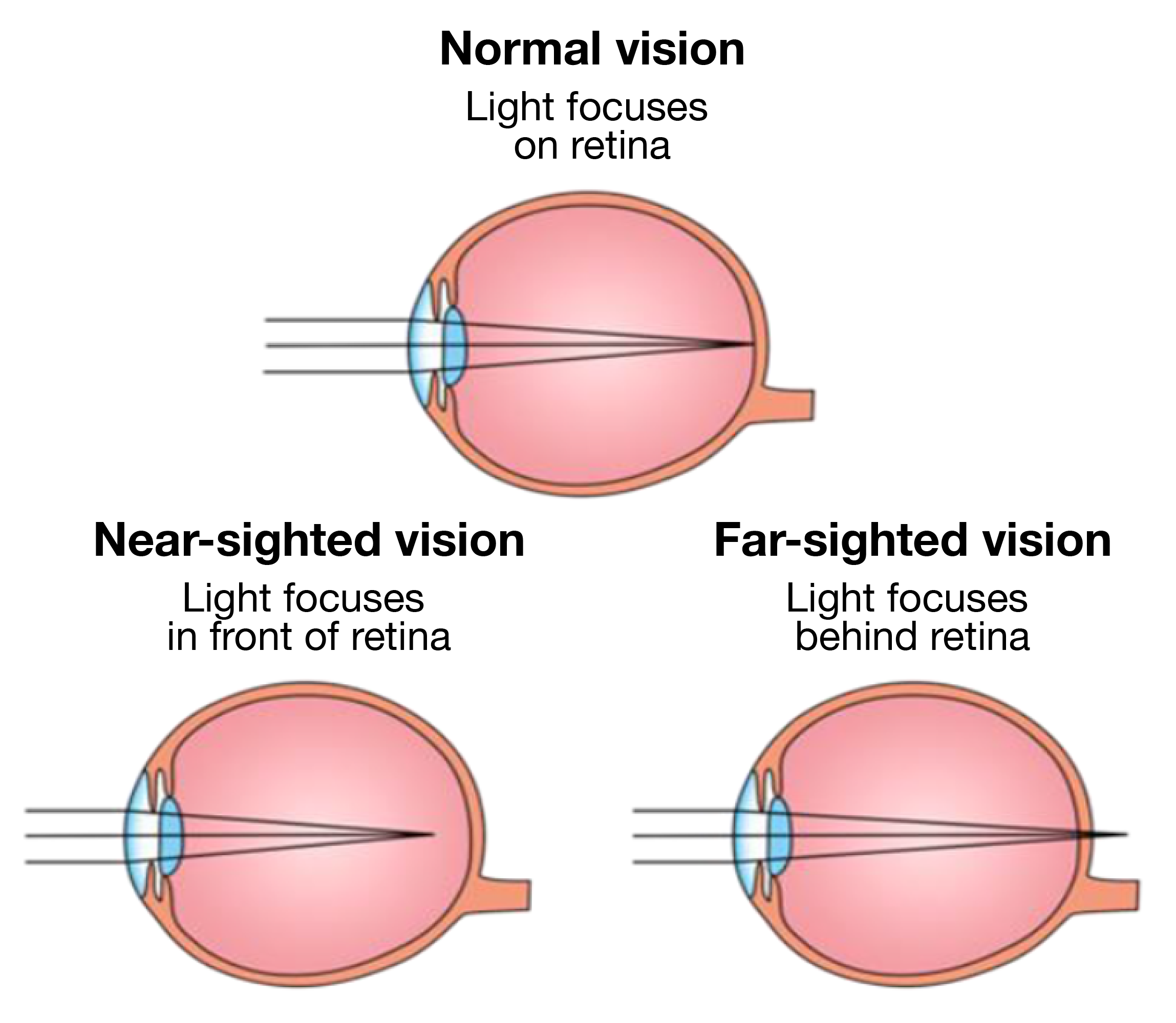 Illustration of where light focuses on the retina in normal, near-sighted and far-sighted vision