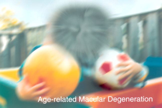 Image of Age-related macular degeneration